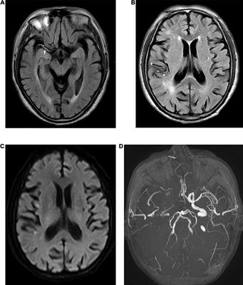 Fluid-Attenuated Inversion Recovery Vascular Hyperintensity in Cerebrovascular Disease: A Review for Radiologists and Clinicians